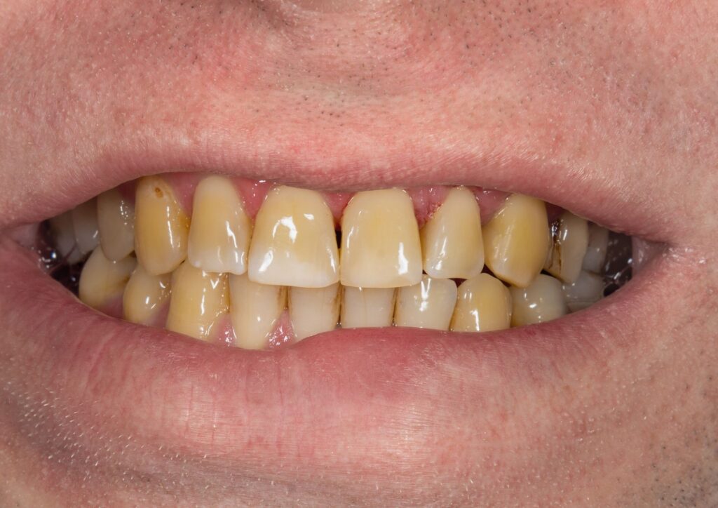  Efectos del tabaco en los dientes